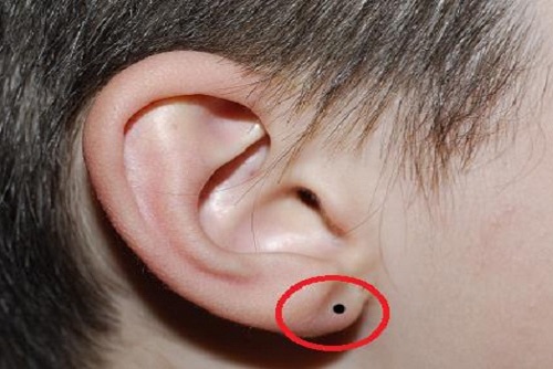 nốt ruồi ở tai phụ nữ