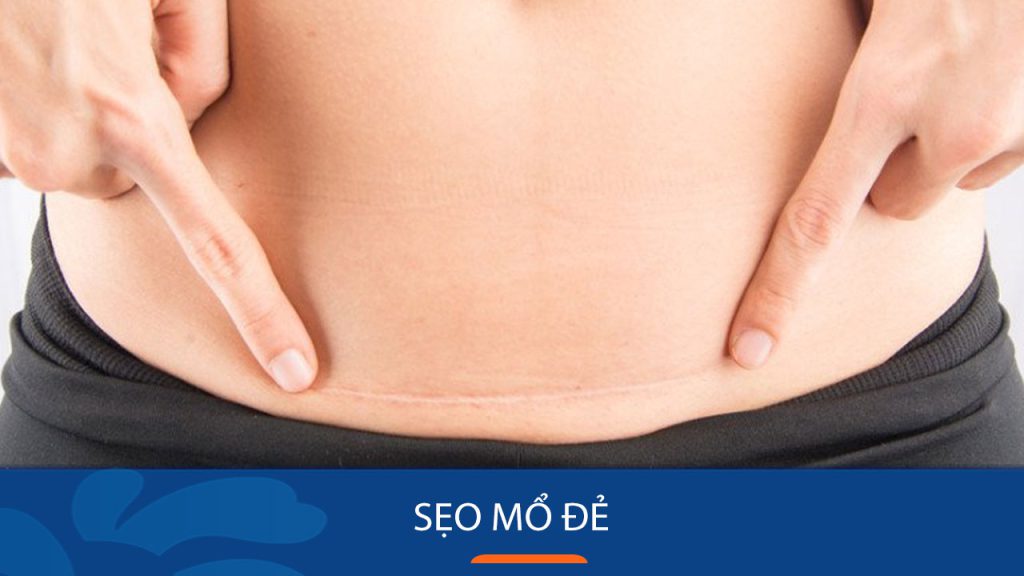 Làm mờ sẹo mổ đẻ: Áp dụng ngay 5 bí quyết đơn giản tại kangnam