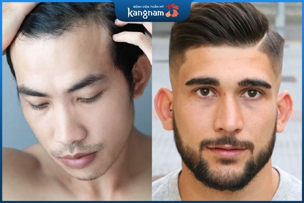 8 kiểu tóc cho nam tóc mỏng trán cao được ưa chuộng nhất 2021