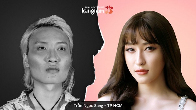 Người mẫu Trần Ngọc Sang lột xác sau khi cấy mỡ mặt trẻ hóa tại Kangnam