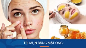 10 Bí Quyết Trị Mụn Nhanh Chóng Hiệu Quả Bằng Mật Ong Tại Nhà