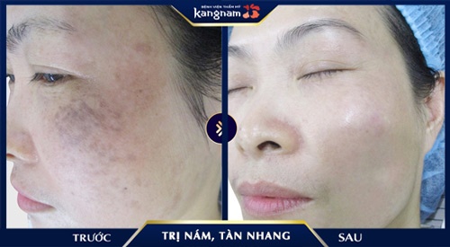 mặt nạ đu đủ và dứa