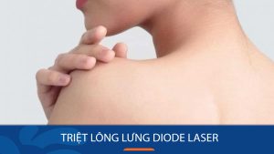 Lột Xác Lưng Thâm Sần Với Công Nghệ Triệt Lông Diode Laser Hiện Đại