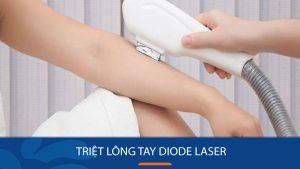Triệt lông tay Diode Laser – Hết sạch lông chỉ sau 1 liệu trình