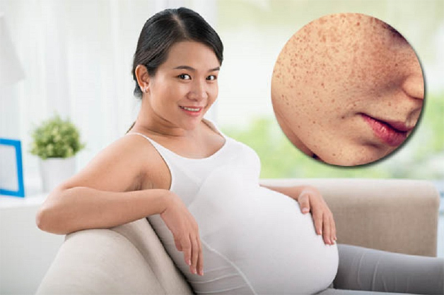 Giai đoạn mang bầu có sự biến đổi mạnh về hormone khiến mụn phát sinh trên da