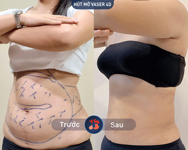 Kết quả trước và sau khi hút mỡ bụng tại Kangnam