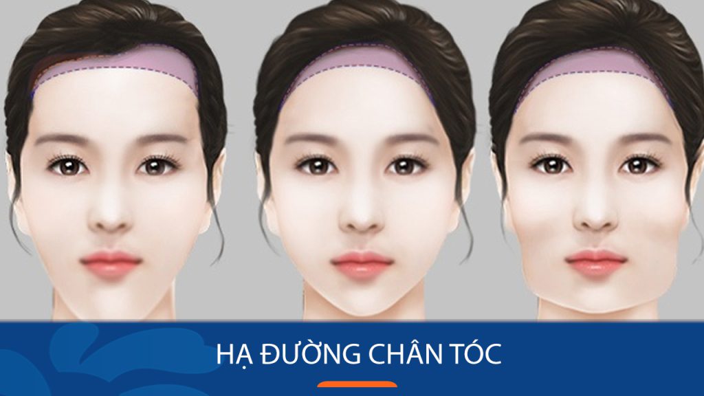 Phẫu thuật hạ đường chân tóc: Giải pháp an toàn khắc phục trán cao – không sẹo, tự tin hơn