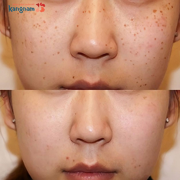 Kết quả trước và sau khi khách hàng điều trị tàn nhang tại Kangnam 