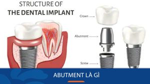 Abutment là gì? Phân loại, so sánh chi tiết Ưu Nhược điểm