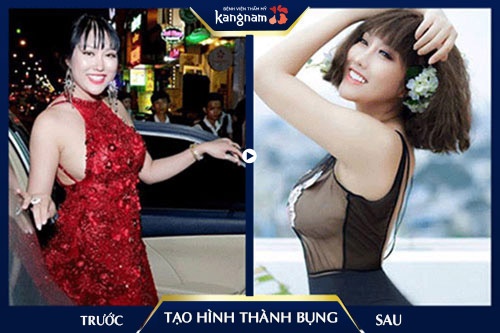 bảng giá tạo hình thành bụng