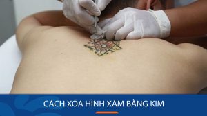 Bất ngờ với cách xóa hình xăm bằng kim không để lại sẹo