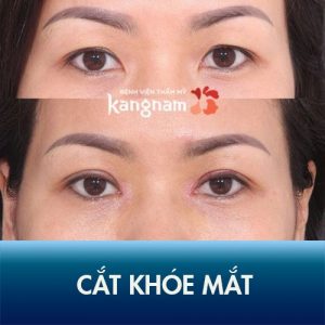 40 phút mở góc mắt tại Kangnam – “Xóa sổ” mắt nhỏ