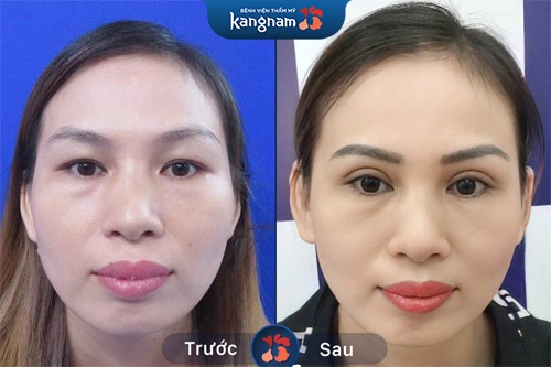 không bị sưng tấy