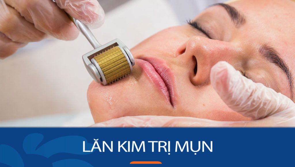 Lăn Kim Trị Mụn Có Tốt Không? Hé Lộ Sự Thật Từ Chuyên Gia