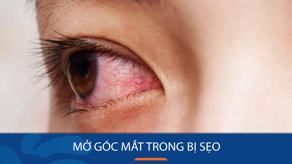 Mở góc mắt Trong/ Ngoài có bị sẹo không? Bao lâu thì lành