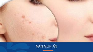 Nặn Mụn Ẩn Tại Nhà: 5 Bước Đơn Giản, An Toàn