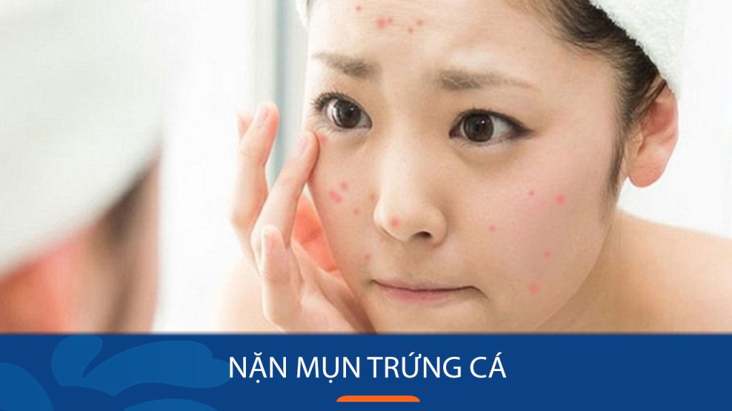 Nặn mụn trứng cá đúng cách tại nhà, không lo thâm sẹo