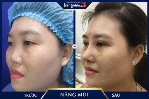 nâng mũi bằng sụn tự thân có tốt không