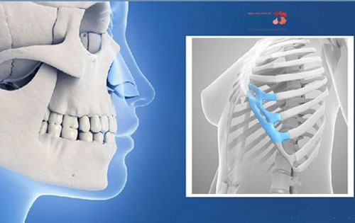 Mô phỏng sụn ở xương số 7 và 8 sử dụng trong nâng mũi sụn sườn tự thân 