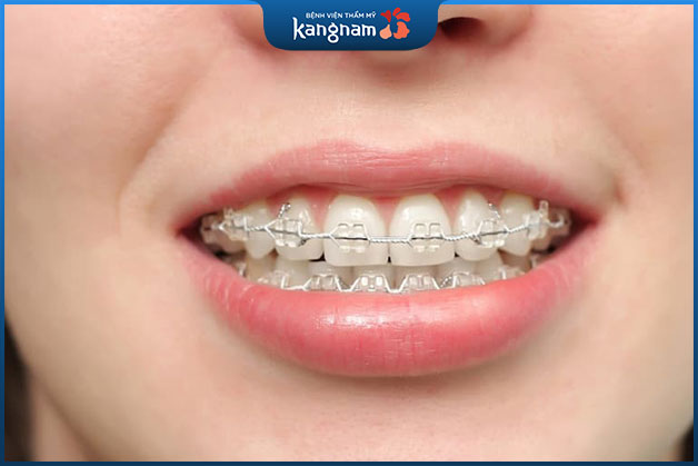 Có nhiều phương pháp chữa cười hở lợi như: niềng răng kết hợp đánh lún, phẫu thuật cắt lợi