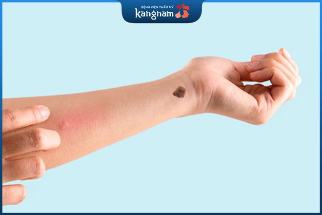 Một nốt ruồi lớn trên cổ tay là khó coi.