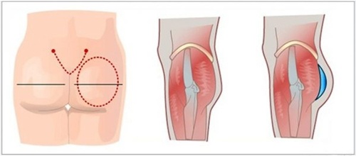 phẫu thuật độn mông