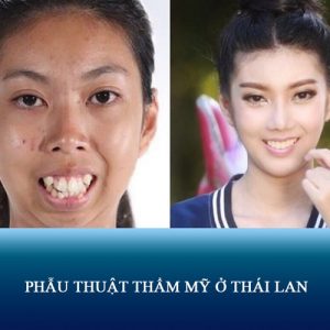 Review thực tế phẫu thuật thẩm mỹ ở Thái Lan Nên hay Không?