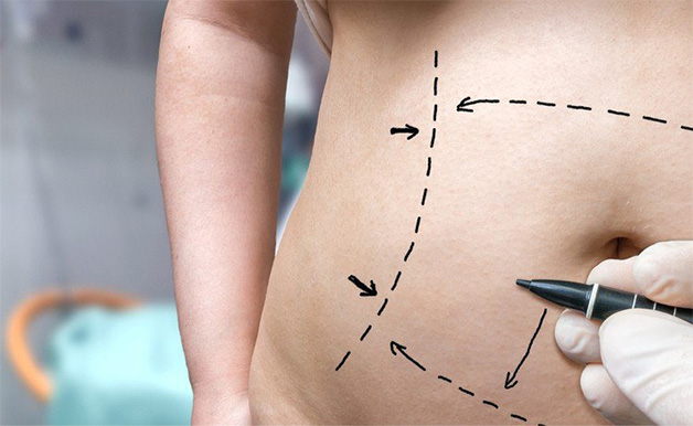 Tạo hình thành bụng là cắt bỏ da, mỡ thừa ở vùng bụng