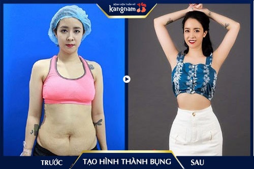 tạo hình thành bụng ở đâu tốt