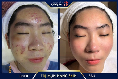 Kết quả khách hàng sau khi điều trị mụn tại Kangnam