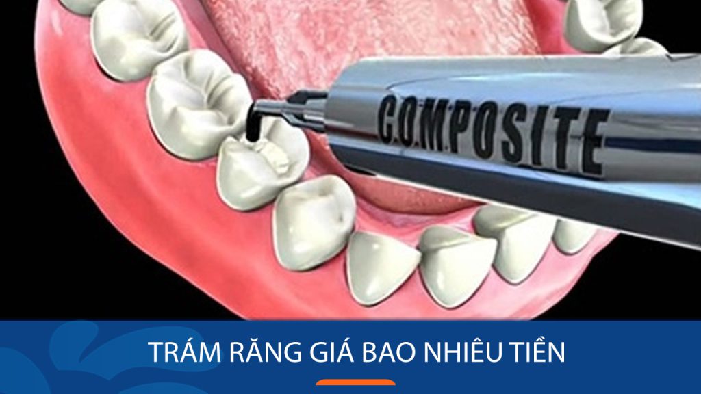 Trám răng giá bao nhiêu tiền? Bảng chi phí hàn răng