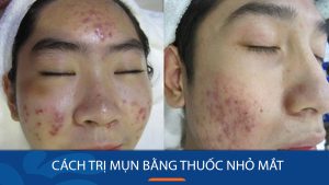 Thuốc nhỏ mắt trị mụn: Giải pháp an toàn và hiệu quả?