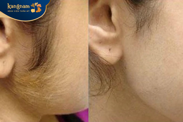 Hình ảnh kết quả tẩy lông mặt bằng công nghệ Diode Laser tại Kangnam