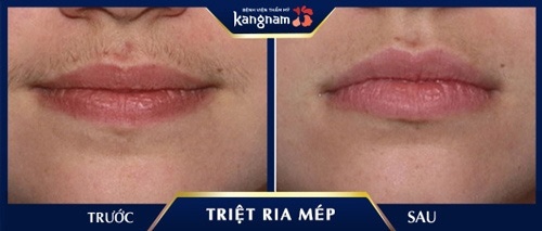 triệt ria mép 