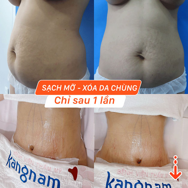 Kết quả sau giảm mỡ bằng công nghệ cao