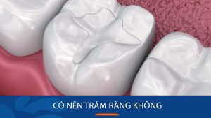 Hàn trám răng thẩm mỹ – Khôi phục toàn diện răng sứt mẻ