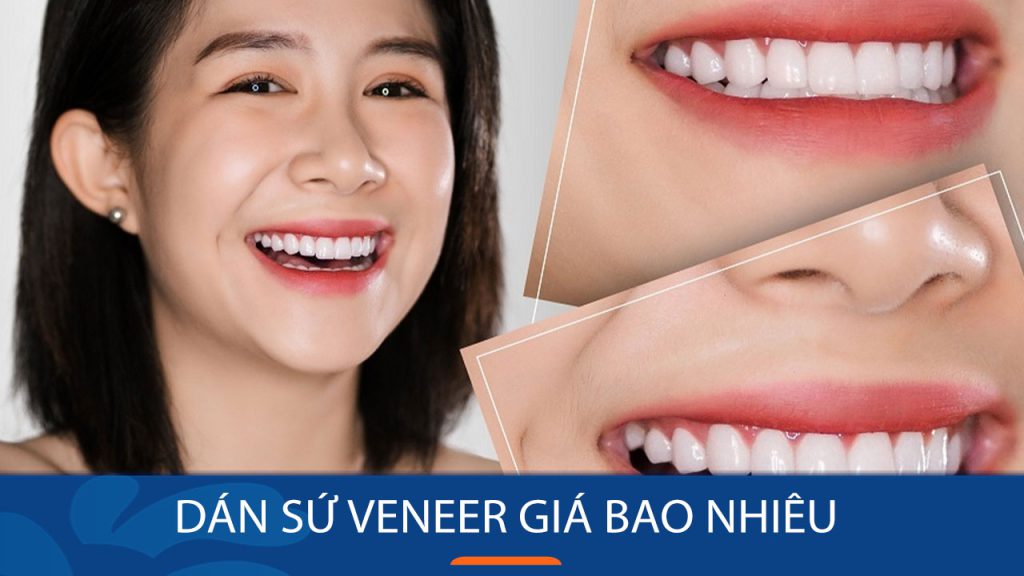 Dán sứ Veneer giá bao nhiêu? Cách đăng kí nhận ƯU ĐÃI
