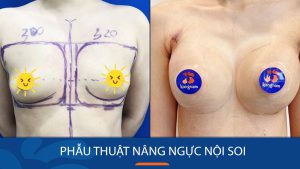Phẫu thuật nâng ngực nội soi – An toàn và hiệu quả cho vòng 1 đẹp