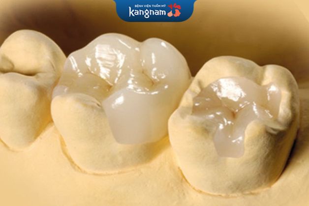 Hình ảnh mô phỏng kết quả sau trám răng hàm inlay onlay