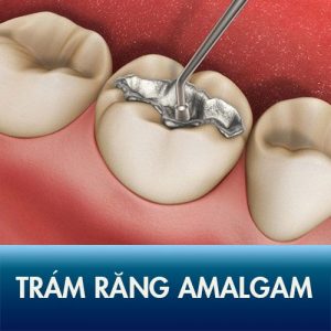 Amalgam là gì? Có nên trám răng bằng chất liệu Amalgam?
