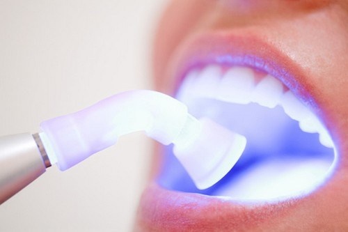 sau khi tẩy trắng răng nên làm gì 