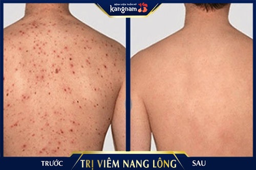 bị viêm chân lông ở vùng kín