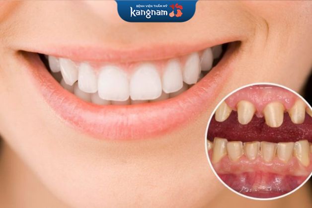 Công nghệ Perfect Smile tại Kangnam cho phép xâm lấn cực ít đến cấu trúc răng thật