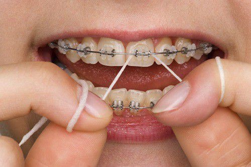 cách làm trắng răng khi niềng răng