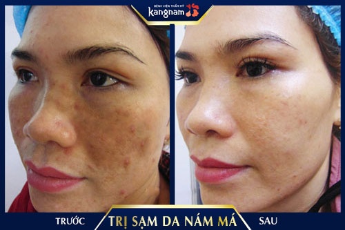 Da trở nên trắng và mịn màng hơn sau khi khách hàng trị sạm da tại Kangnam 