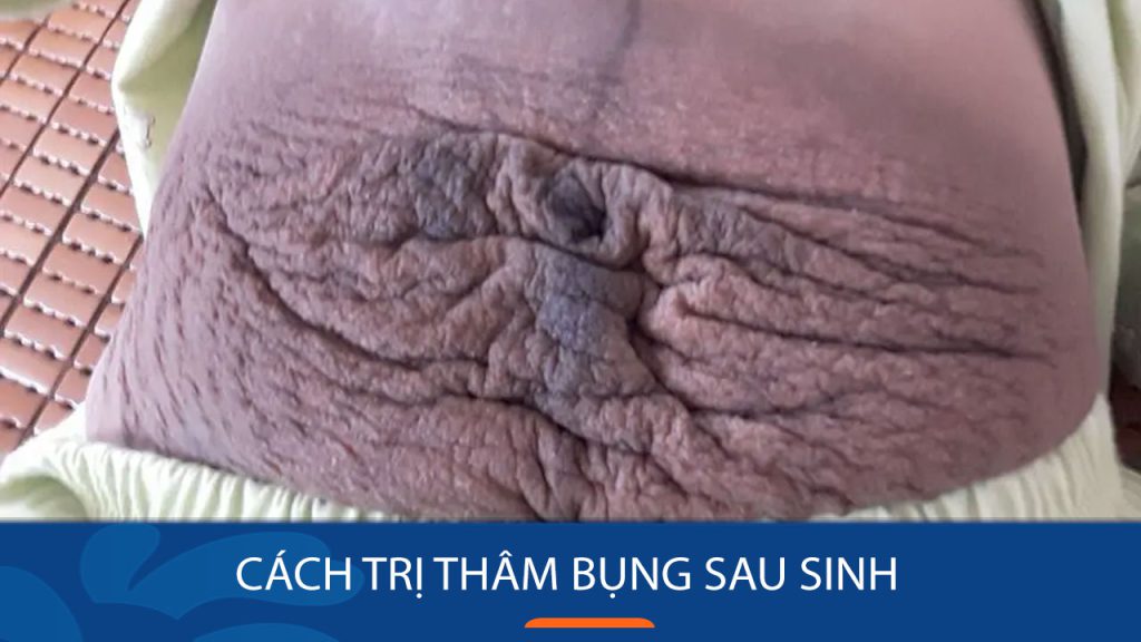 4 Cách trị thâm bụng sau sinh – Mờ vết thâm tới 90%