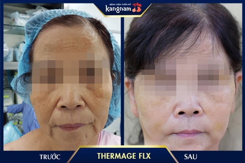 cơ mặt chảy xệ 