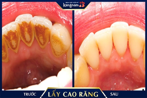 có bầu đi lấy cao răng được không 