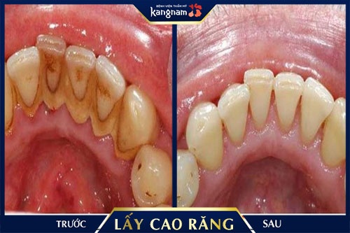 có bầu có đi lấy cao răng được không