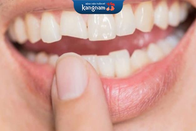 Trường hợp răng nhiễm màu, mẻ vỡ có thể lựa chọn dán sứ Veneer hoặc bọc sứ